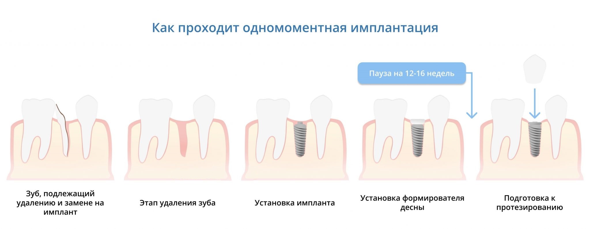 Процесс одномоментной имплантации зубов