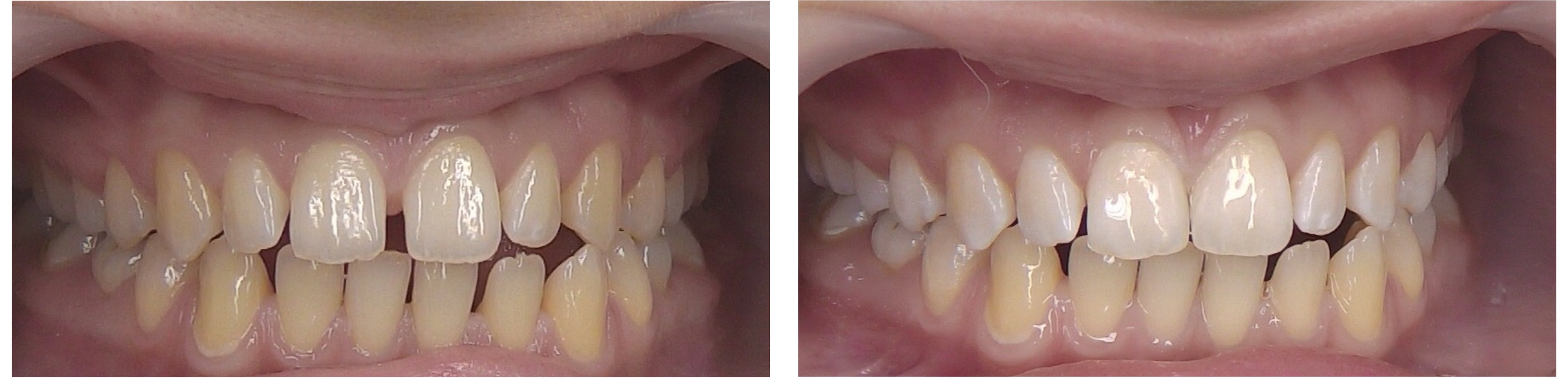 Фото до и после лечения диастемы