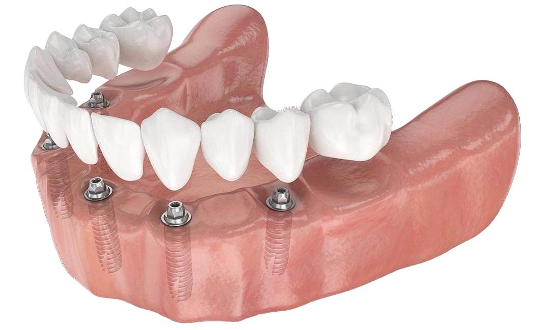 Условно-съемный зубной протез