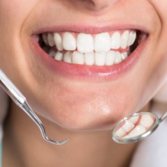 Художественная реставрация зубов в стоматологии НАВА