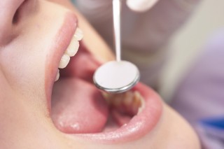 Осмотр полости рта на наличие кандидозного стоматита
