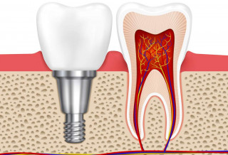 Осложнения после имплантации зубов