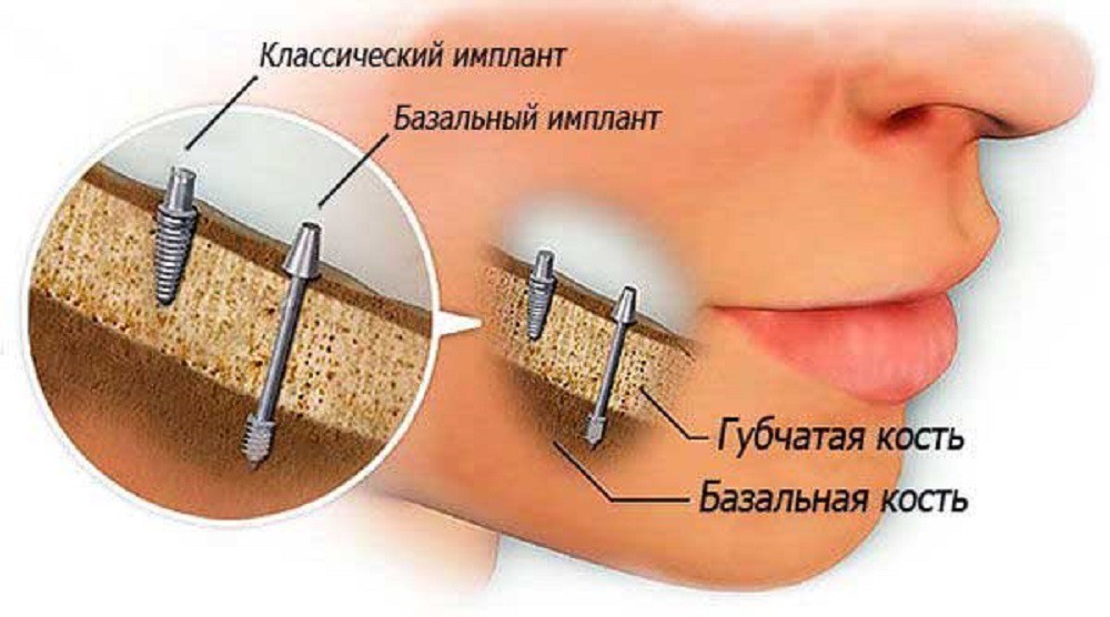 Базальный имплант в челюсти