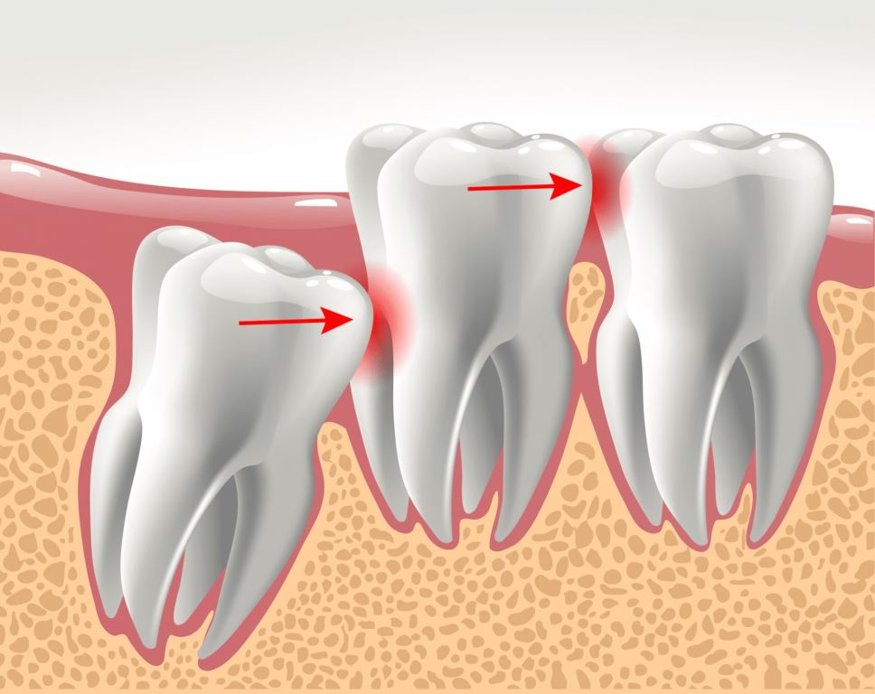 Сроки и порядок прорезывания постоянных зубов