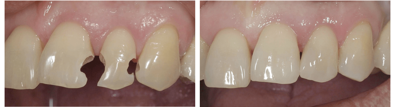фото до и после реставрации зубов