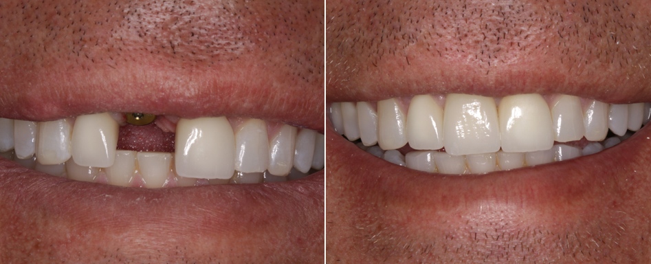 Имплантация зуба до и после операции