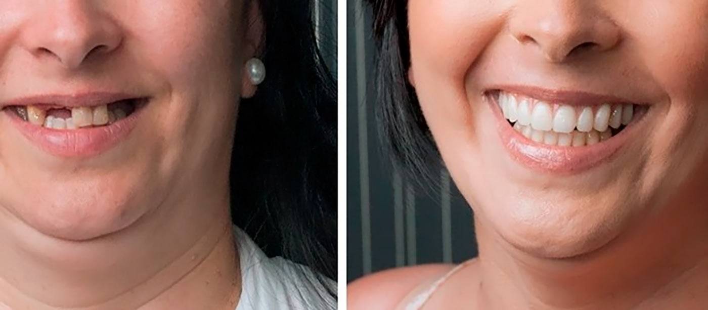 Фото до и после имплантации зубов на верхней челюсти