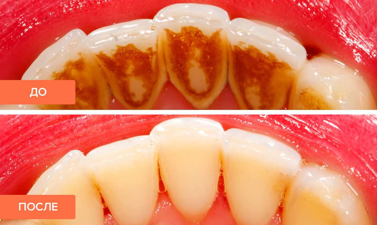 Фото до и после профессиональной гигиены полости рта