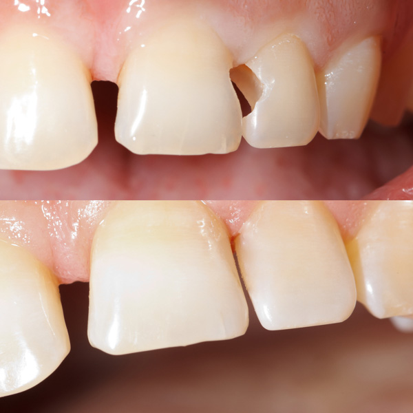 Фото до и после пломбирования зуба