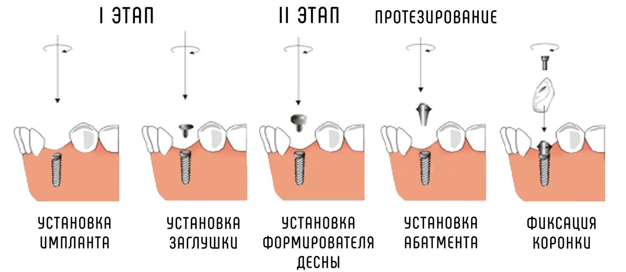 Двухэтапная имплантация зубов пошагово