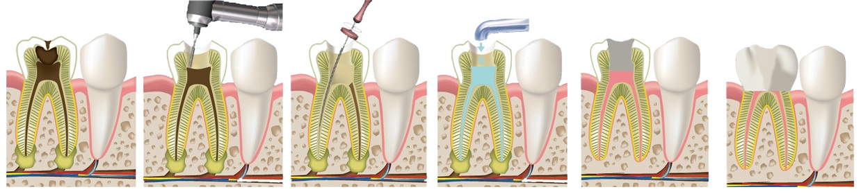 Эндодонтическое лечение корневых каналов зуба