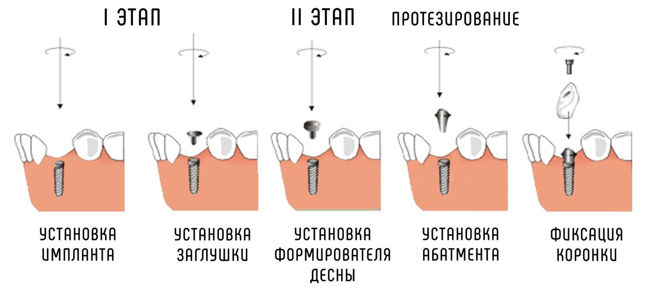 Этапы имплантации нижней челюсти