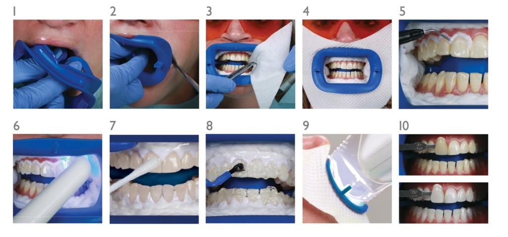 Этапы отбеливания зубов методом zoom