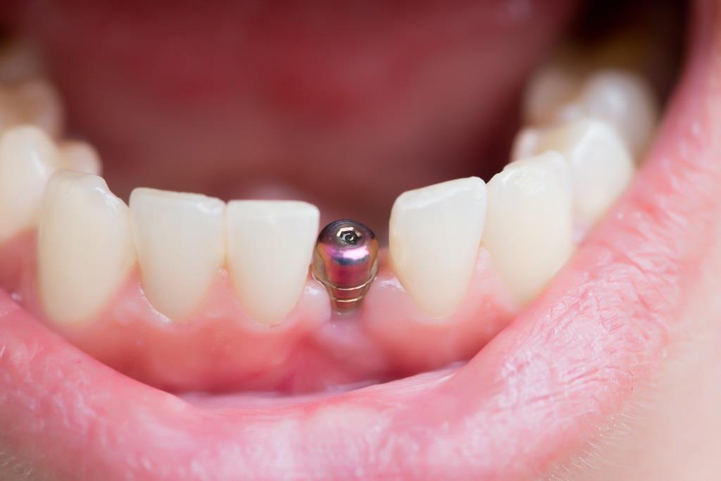 Имплант зуба на нижней челюсти
