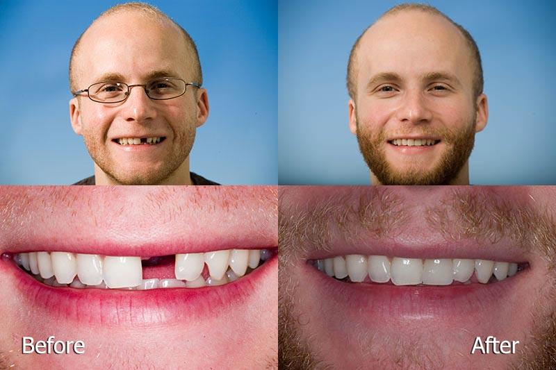 До и после имплантации переднего зуба