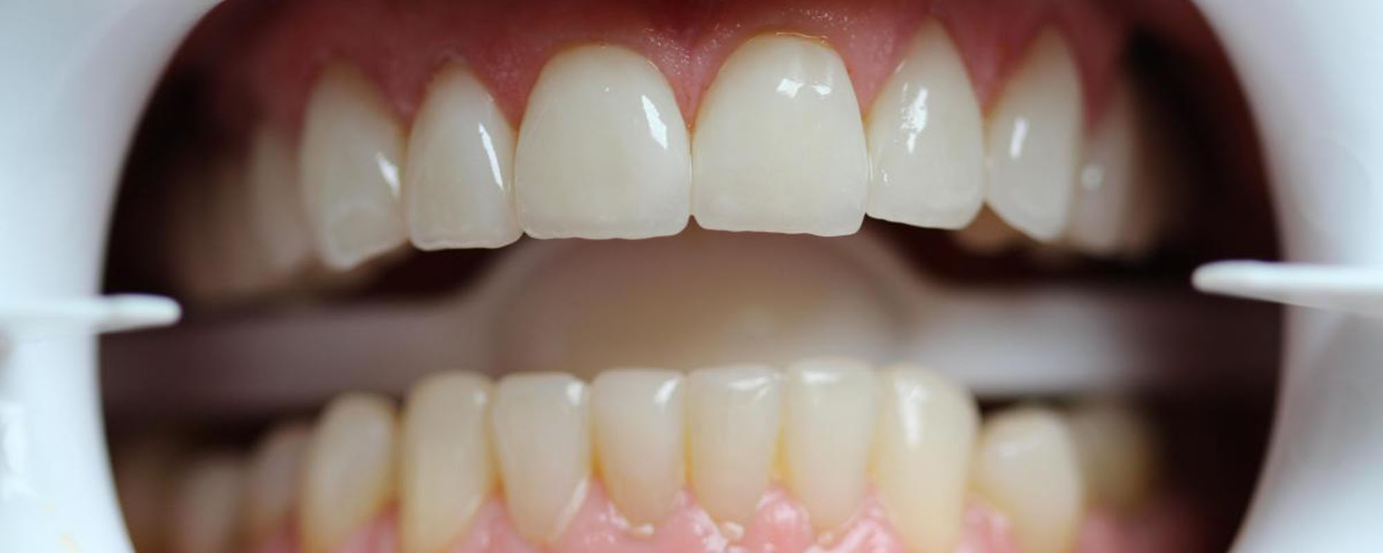 Фото челюсти с зубными коронками