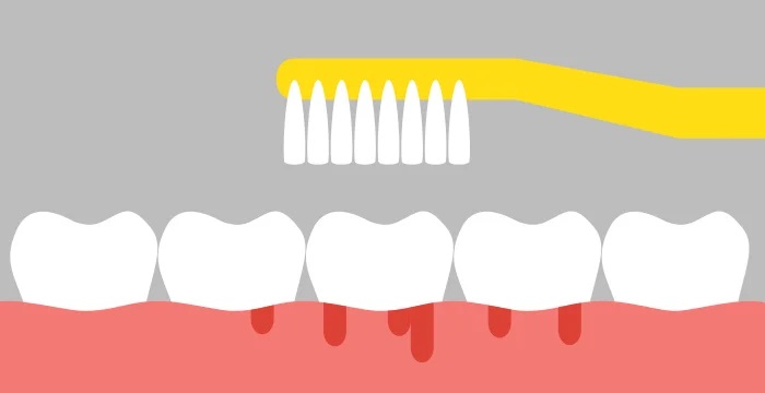 Кровь на деснах во время чистки зубов