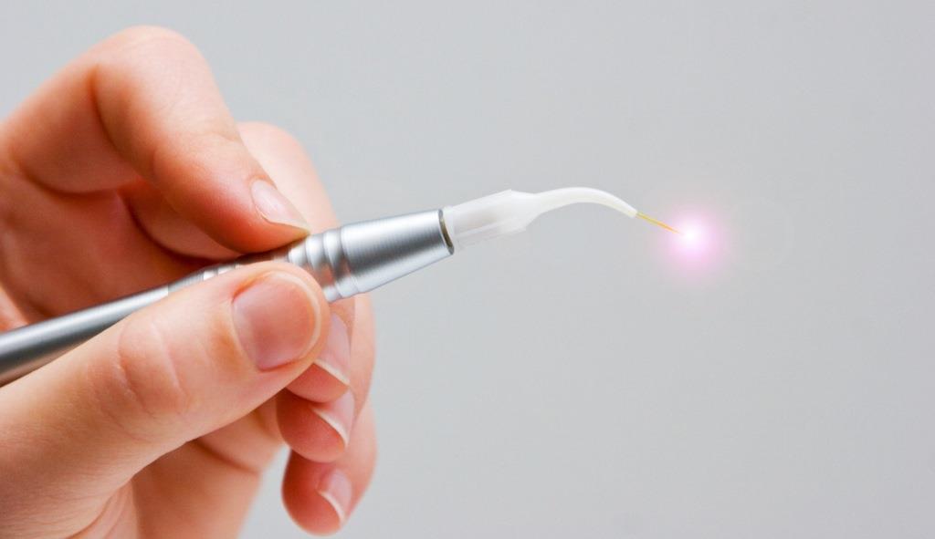 Лазер для чистки зубного камня