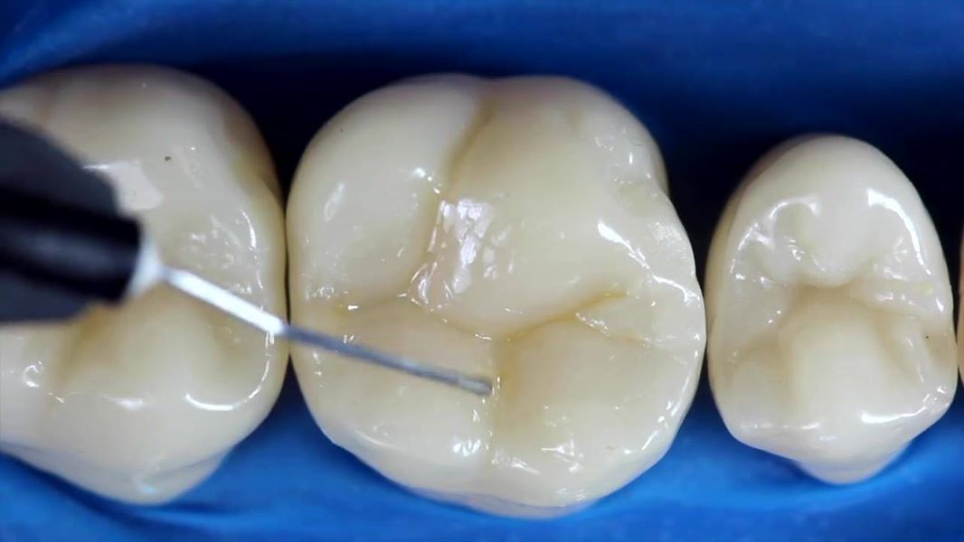 Здоровый зуб после лечения фиссурного кариеса