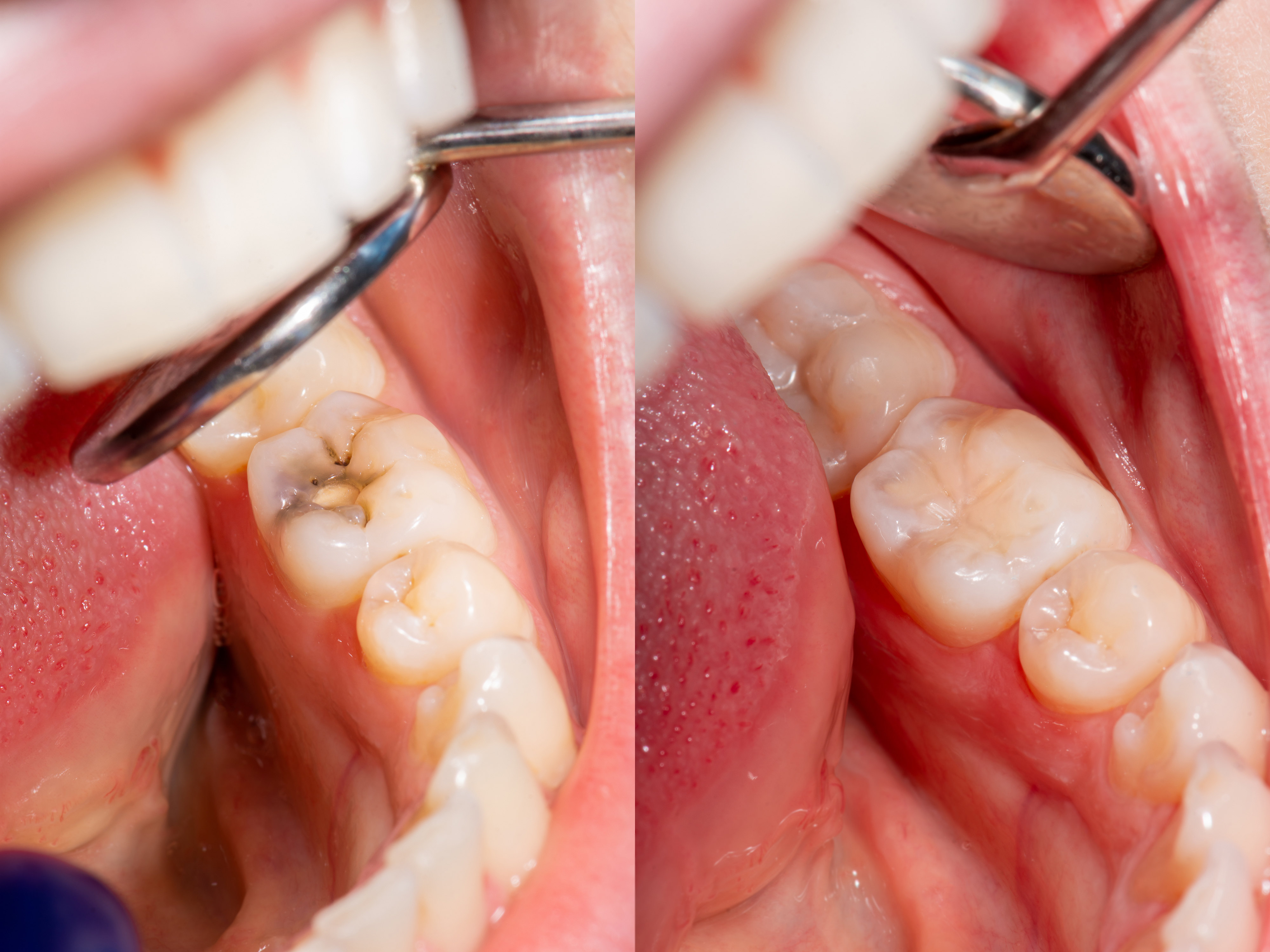 Лечение гнилых зубов: до и после