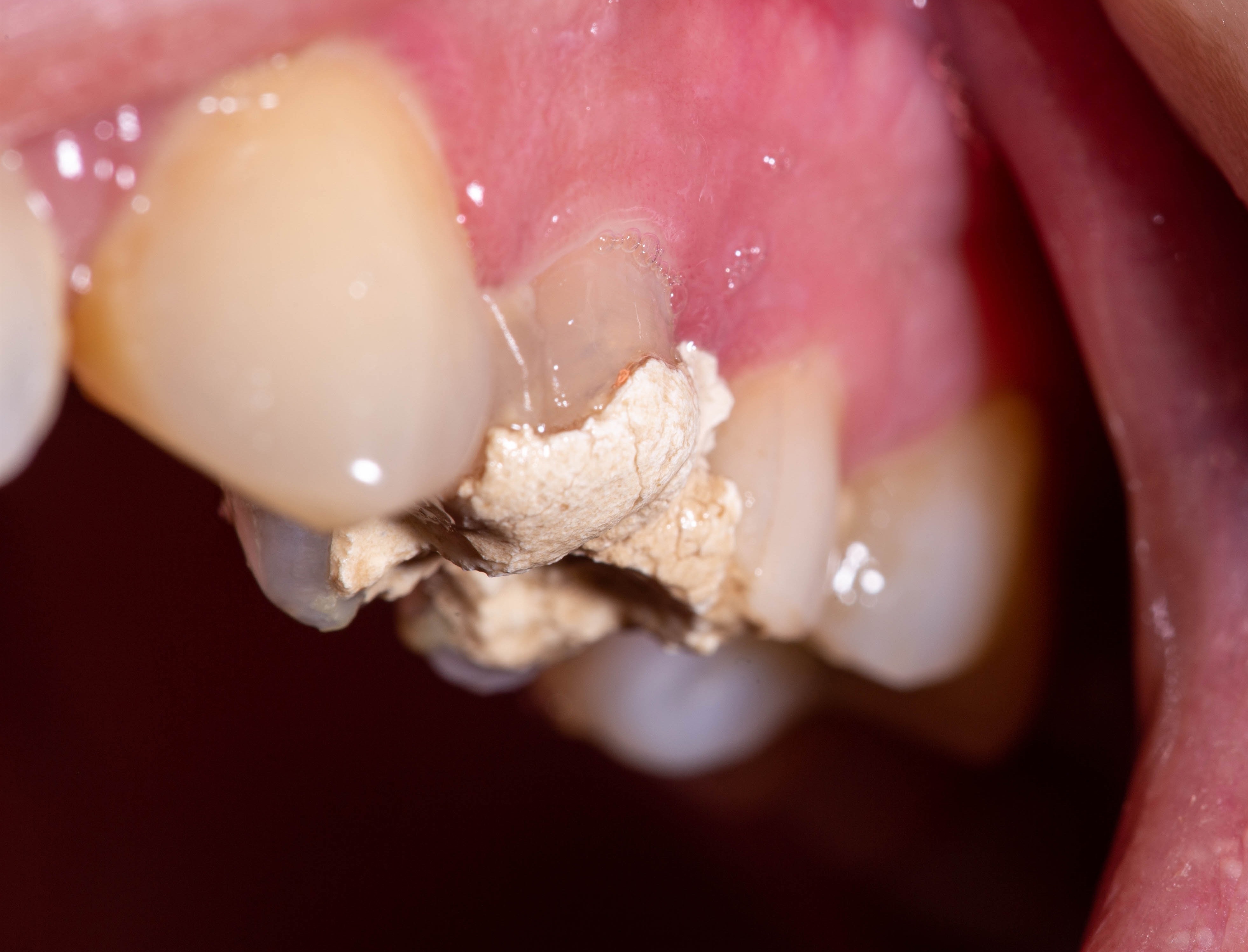пульпит зуба, лечение