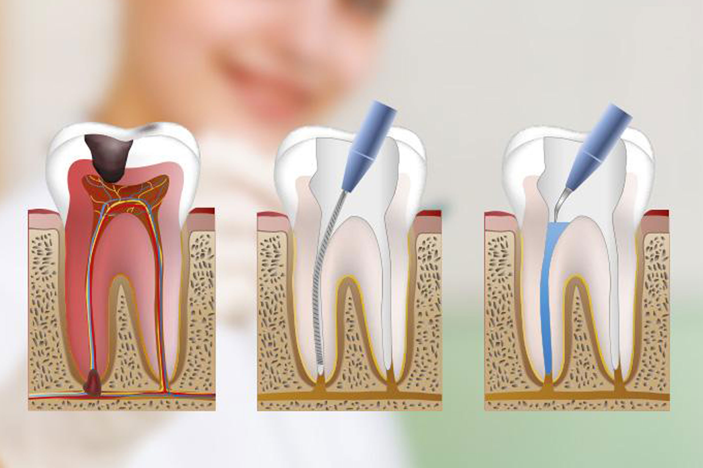 Назначение эндодонтической стоматологии