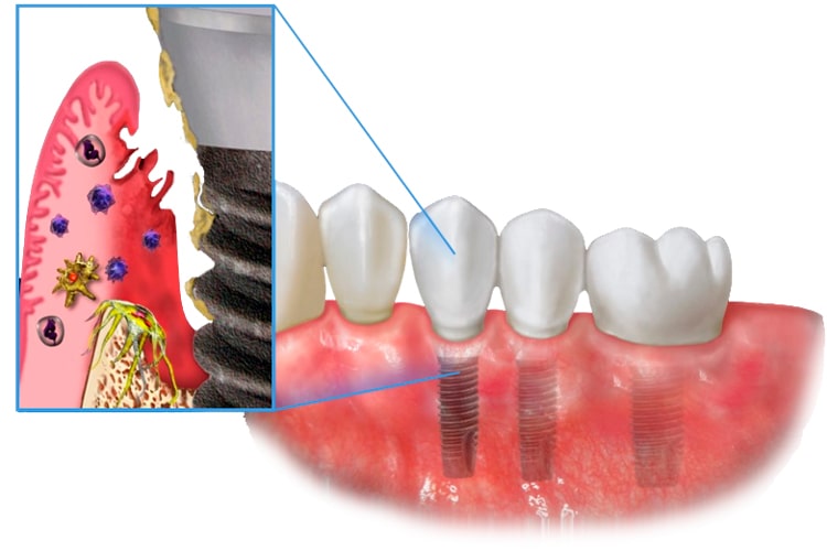 Изображение как выглядит отторжение зубного импланта
