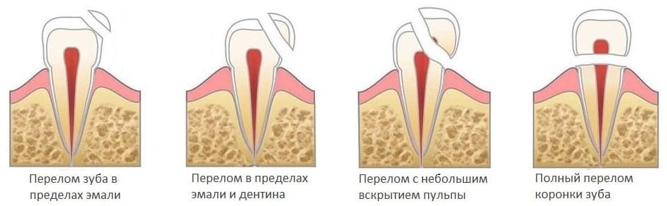 Изображение видов перелома зуба