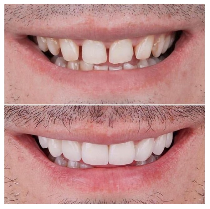 Щели между зубами: до и после
