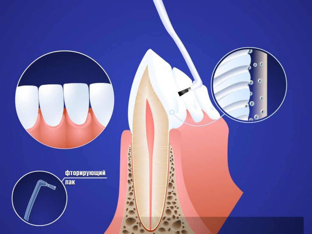 Процедура фторирования зубов