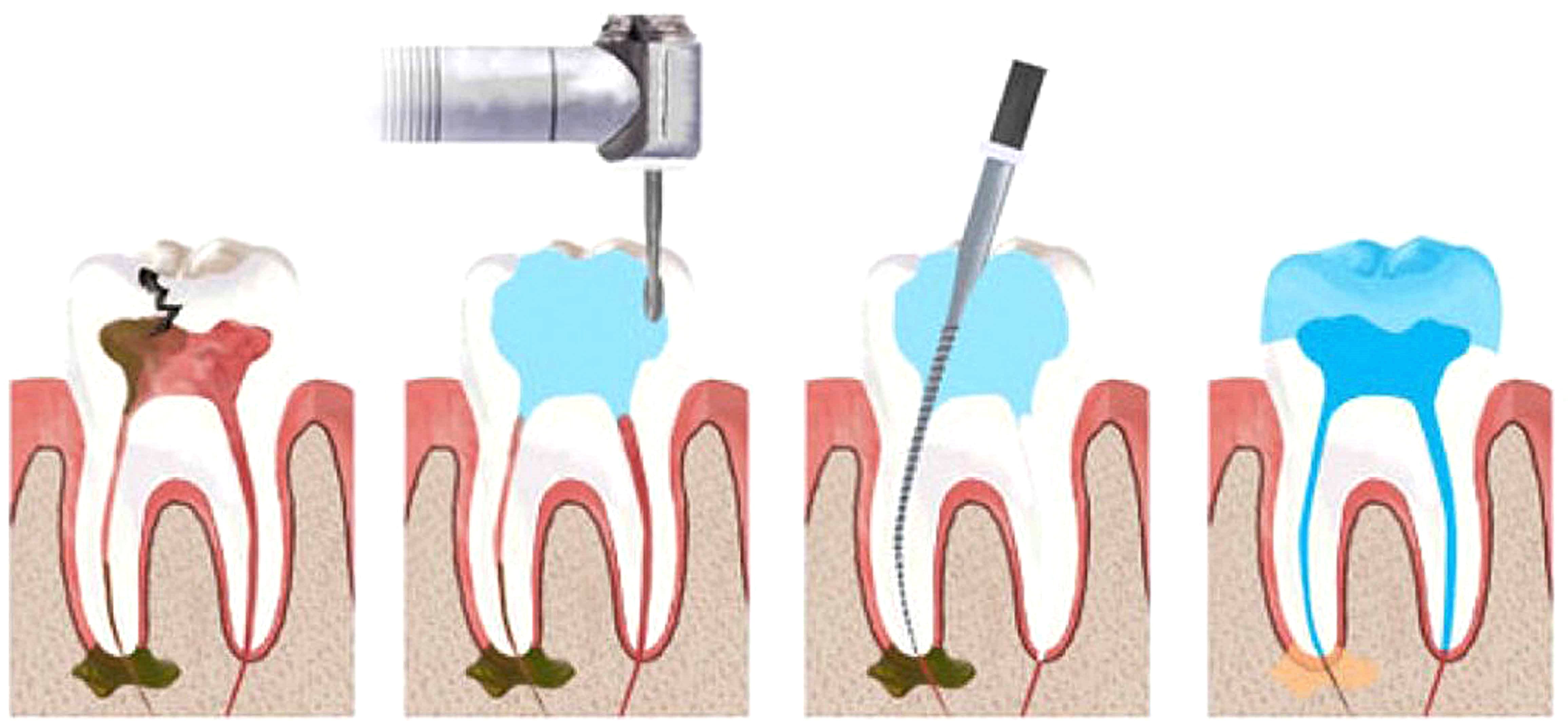 Процесс удаления зубного нерва