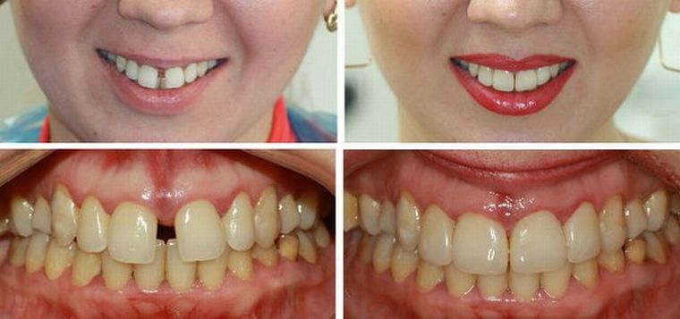 Промежуток между зубами, до и после лечения