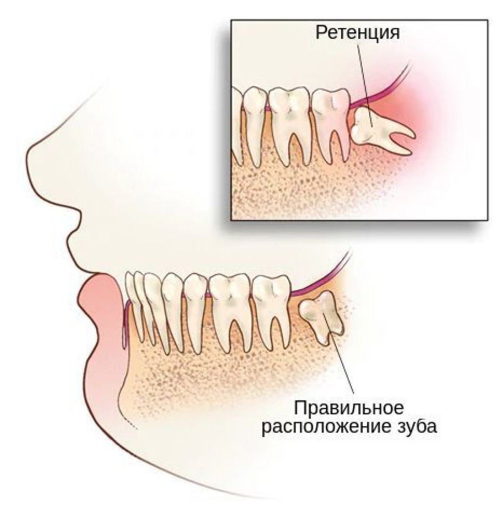 Ретенция зуба