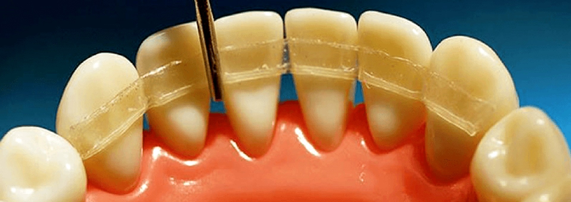 Шинирование зубов при пародонтозе