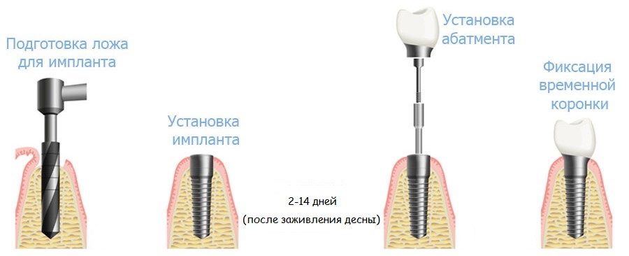 Изображение схемы одноэтапной имплантации зубов