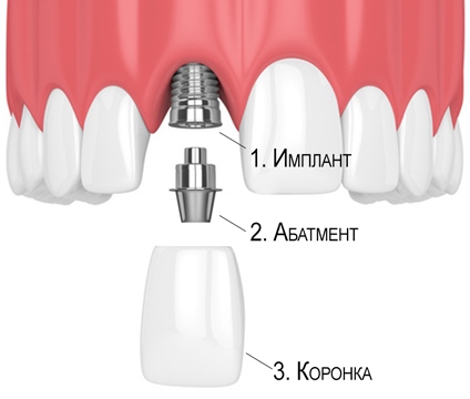 Строение зубного импланта