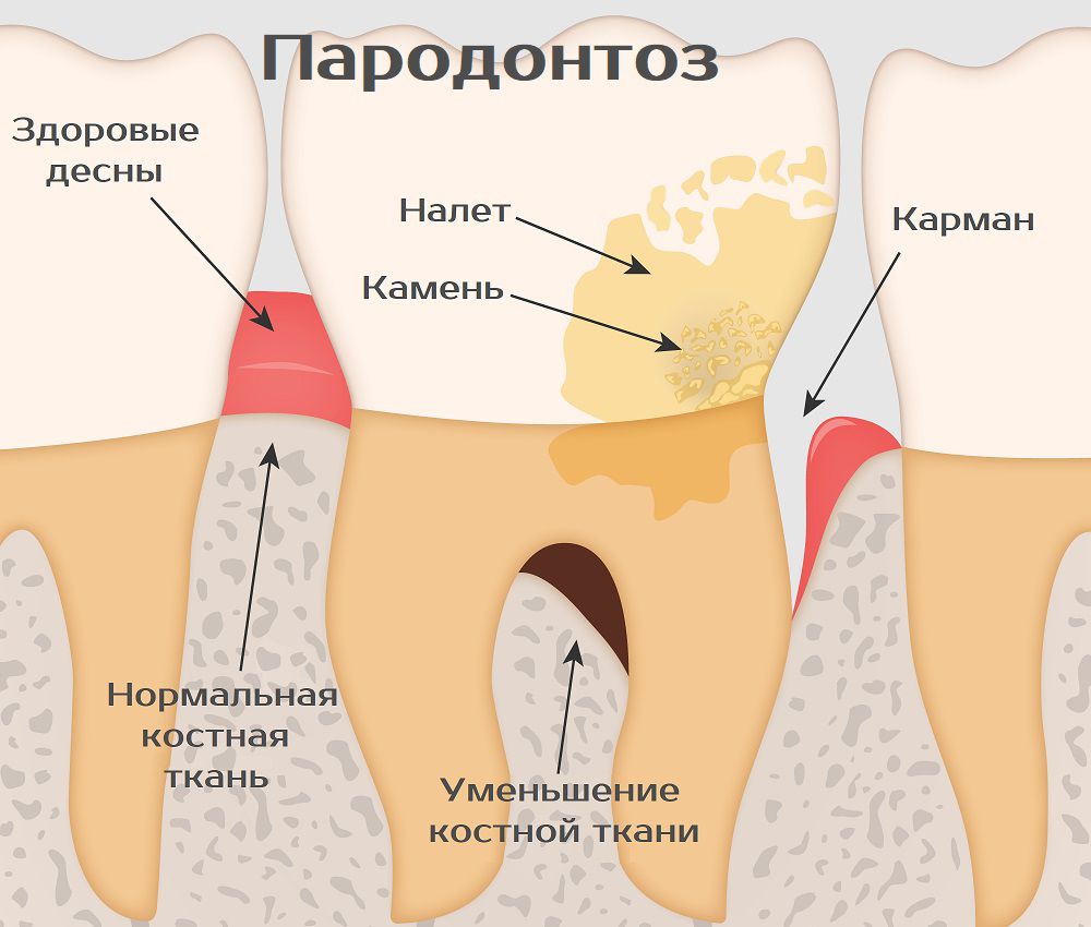 Строение зуба с пародонтозом