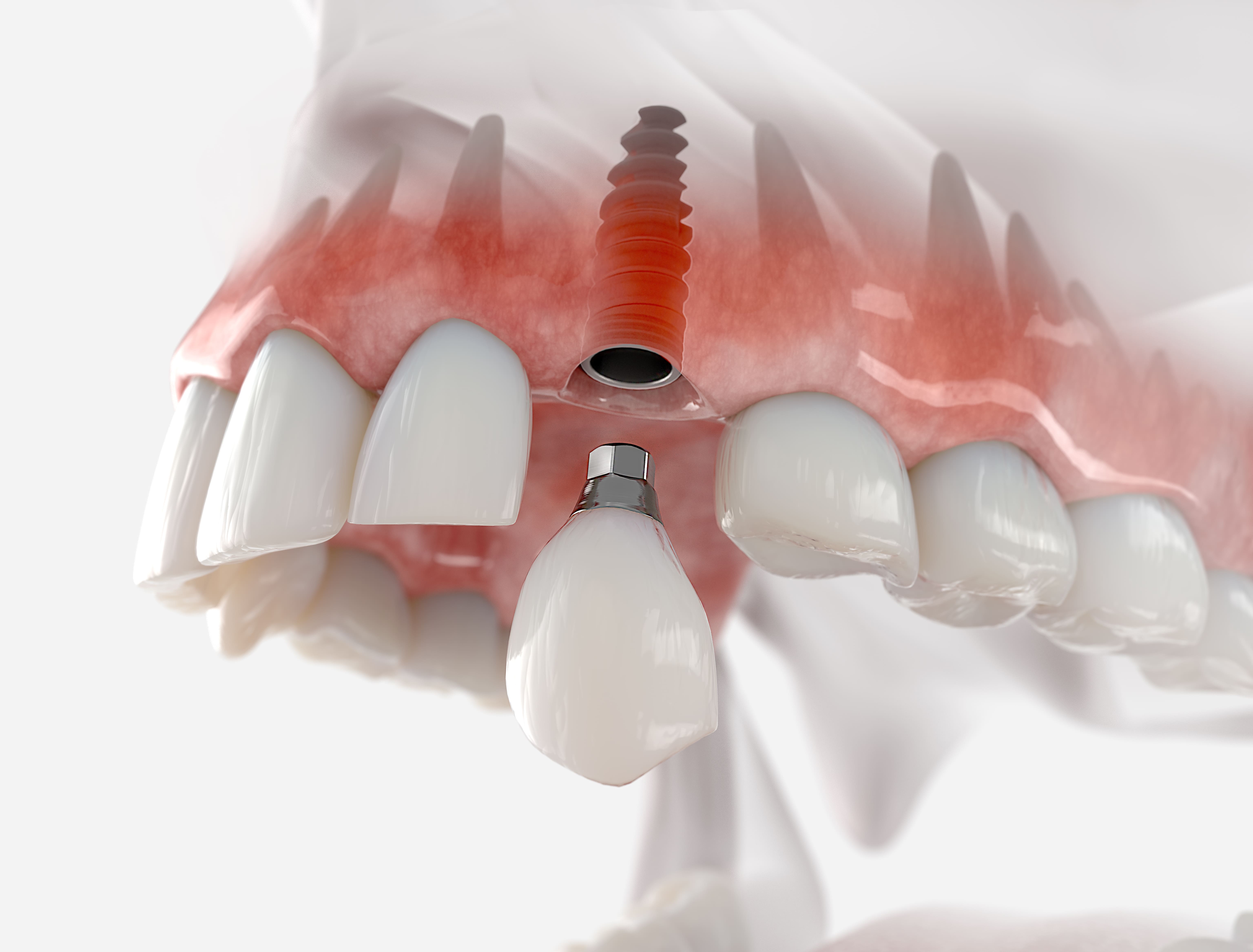 Фото технология имплантации зубов