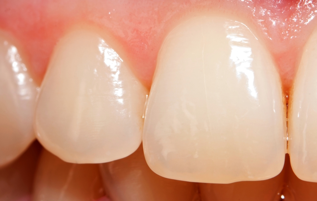 Фото зубов с трещиной на эмали