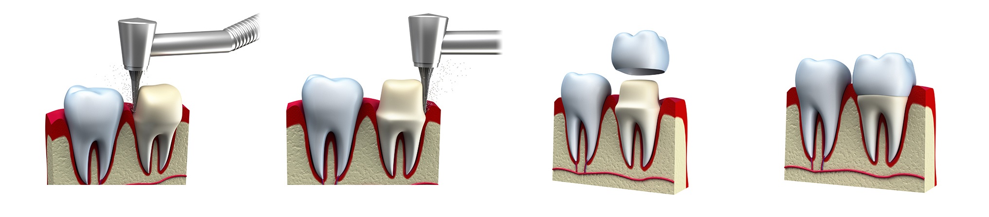 Процесс установки коронки на жевательный зуб