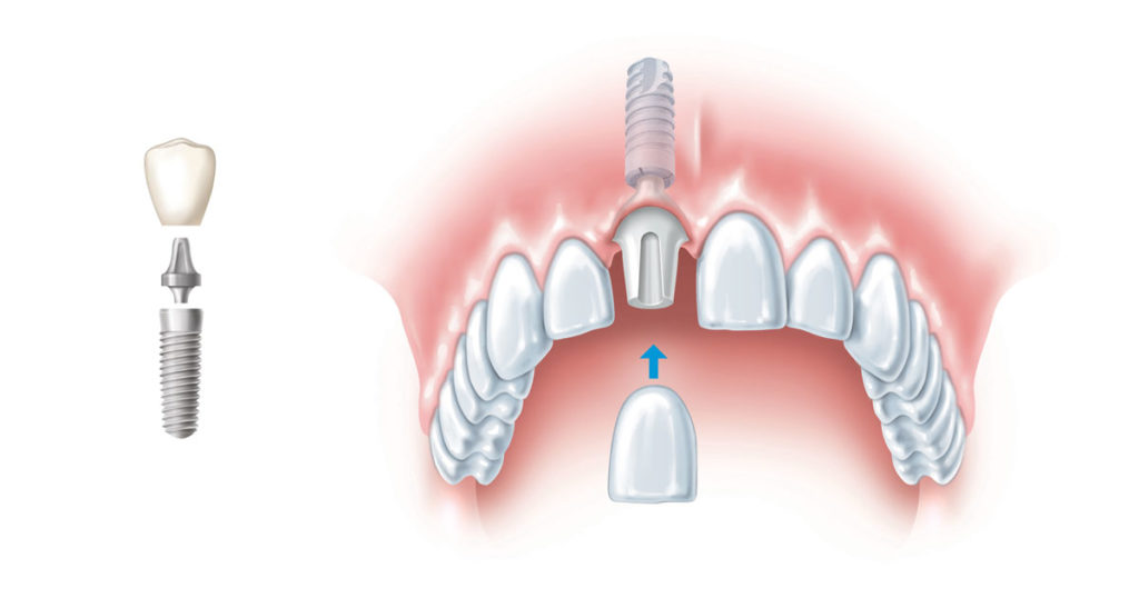 Установка импланта на передний зуб