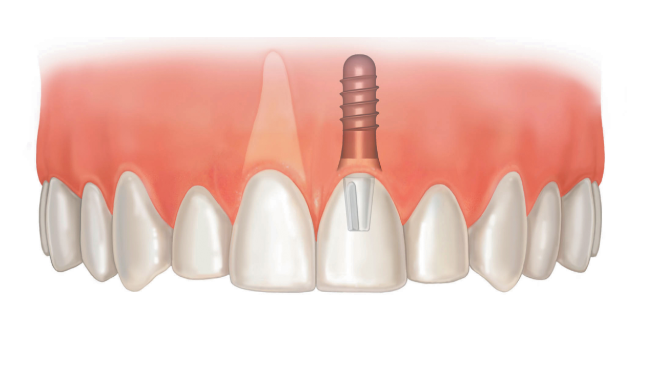Верхний зубной имплант