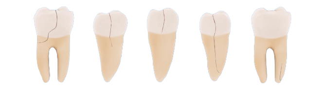 Виды зубных трещин