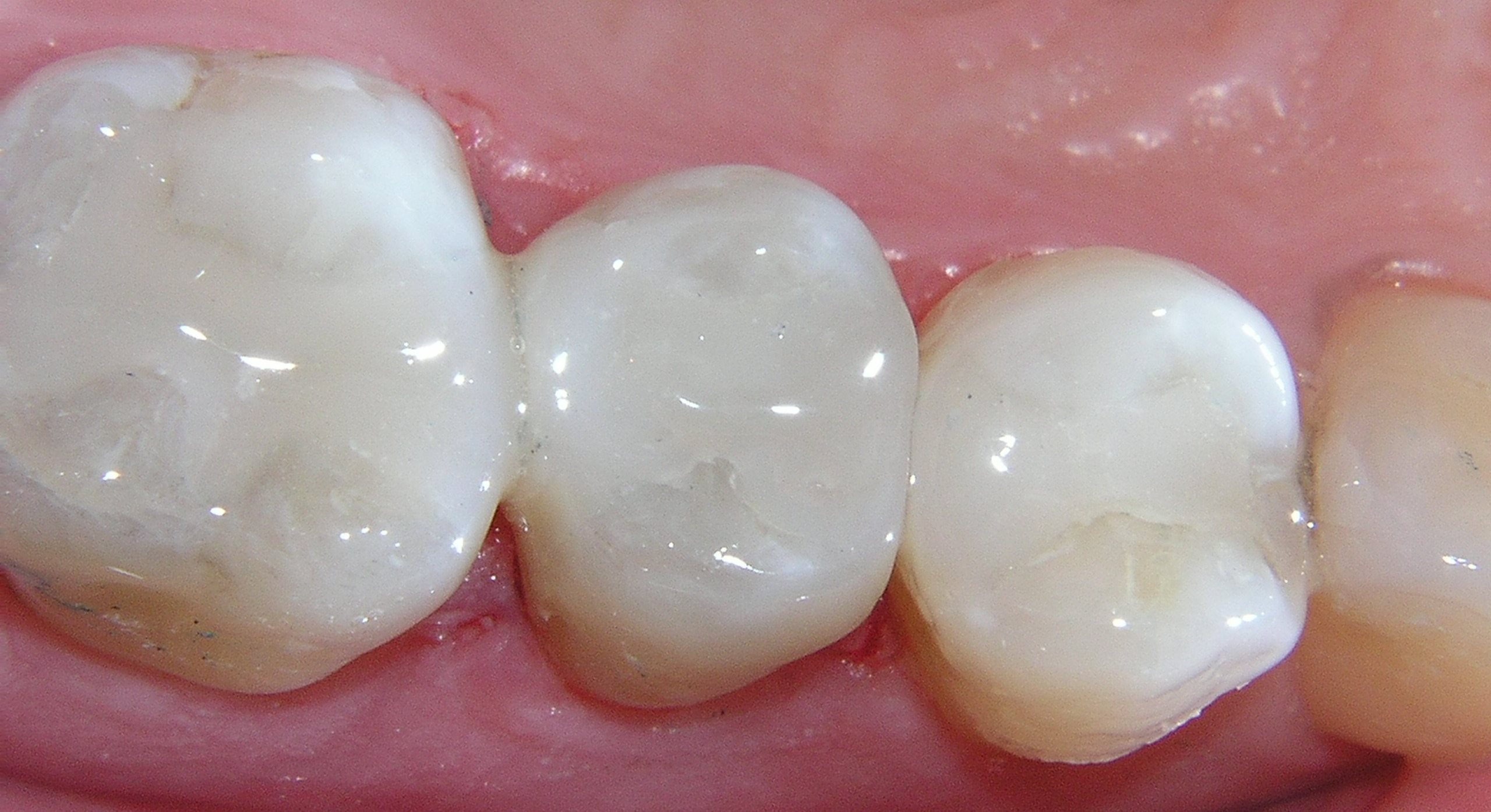 Зубные пломбы под замену