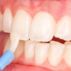 Фторирование зубов в стоматологии