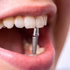 Привыкание к зубному импланту