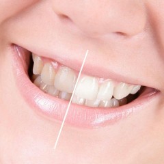 Изменение оттенка эмали зуба