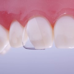 Тонкая зубная эмаль