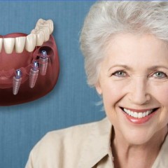 Фото женщины после имплантации зубов