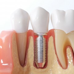 Изображение зубного импланта